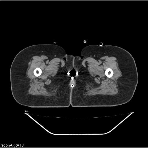 File:Carcinoma cervix- brachytherapy applicator (Radiopaedia 33135-34173 Axial non-contrast 61).jpg