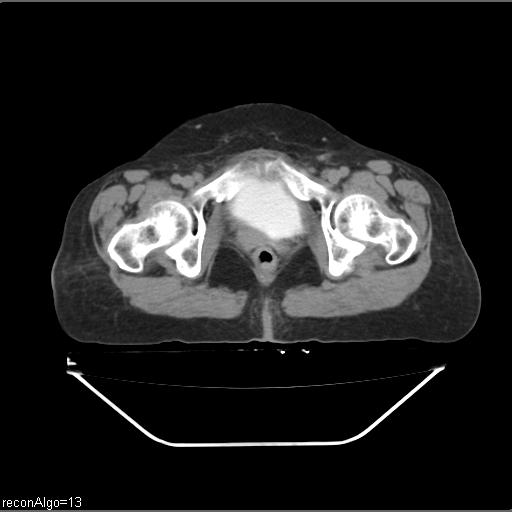 File:Carcinoma cervix- recurrence (Radiopaedia 34702-36137 B 89).jpg