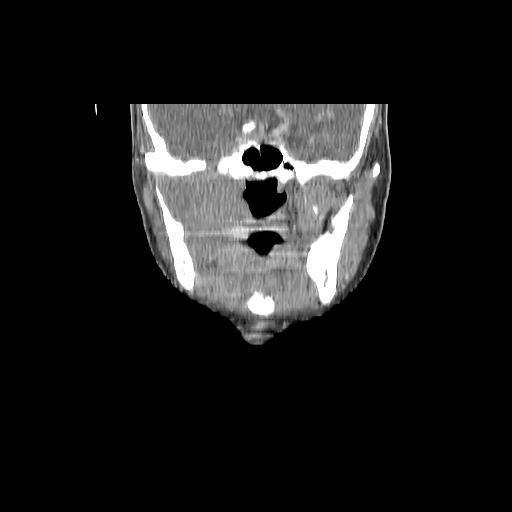 Carcinoma of the maxillary antrum (Radiopaedia 53805-59888 Coronal C+ delayed 71).jpg