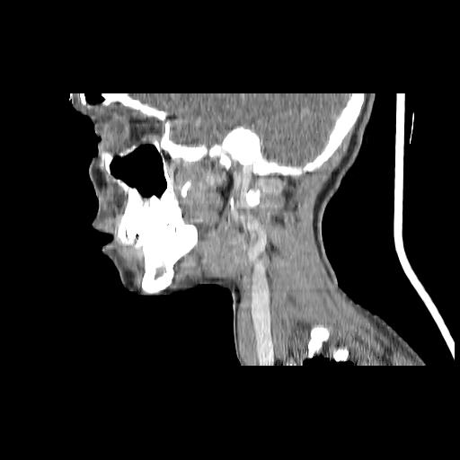 Carcinoma of the maxillary antrum (Radiopaedia 53805-59888 Sagittal C+ delayed 127).jpg