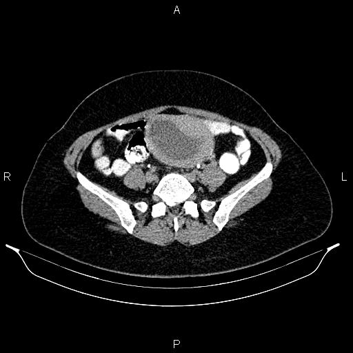 File:Carcinoma of uterine cervix (Radiopaedia 85861-101700 Axial C+ delayed 59).jpg