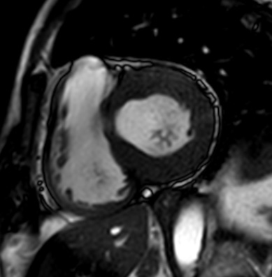 Cardiac amyloidosis - ATTR wild-type (Radiopaedia 74412-85296 short axis cine SSFP 127).jpg