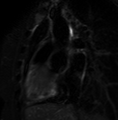 File:Cardiac sarcoidosis (Radiopaedia 74548-85466 2ch STIR 8).jpg
