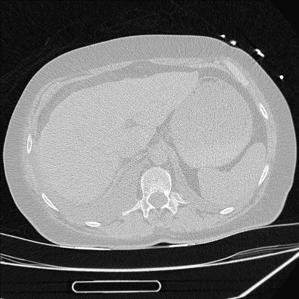 Cardiogenic pulmonary edema (Radiopaedia 29213-29609 Axial lung window 103).jpg