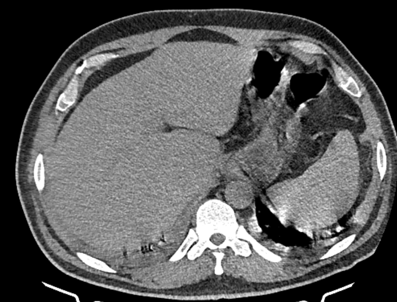 Cardiogenic pulmonary edema (Radiopaedia 68180-77678 Axial non-contrast 54).jpg