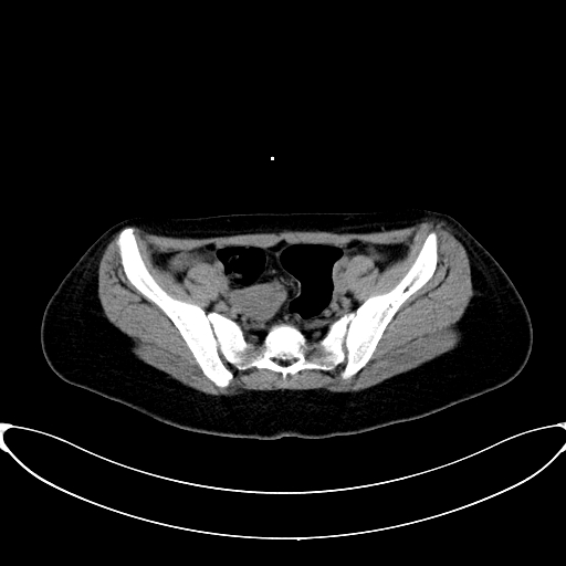Caroli disease with medullary sponge kidney (Radiopaedia 82622-96804 Axial non-contrast 60).jpg