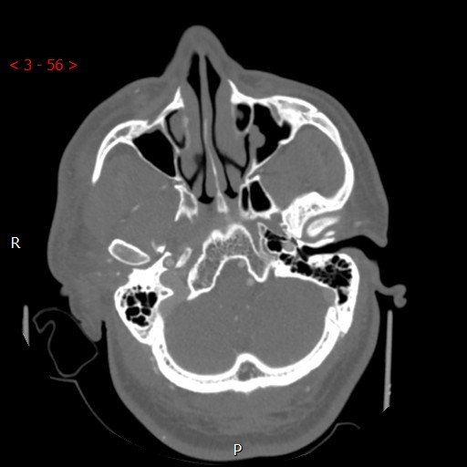 Caroticocavernous fistula (Radiopaedia 42346-45457 A 14).jpg