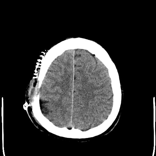 File:Carotid arterial dissection (Radiopaedia 30001-30548 Axial non-contrast 24).jpg