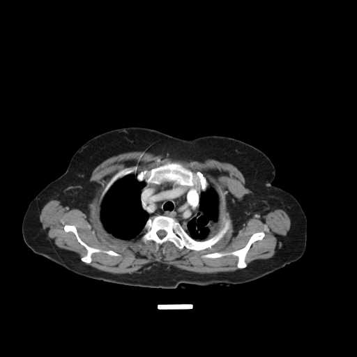 File:Carotid body tumor (Radiopaedia 21021-20948 B 27).jpg