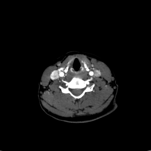 File:Carotid body tumor (Radiopaedia 39845-42300 B 10).jpg