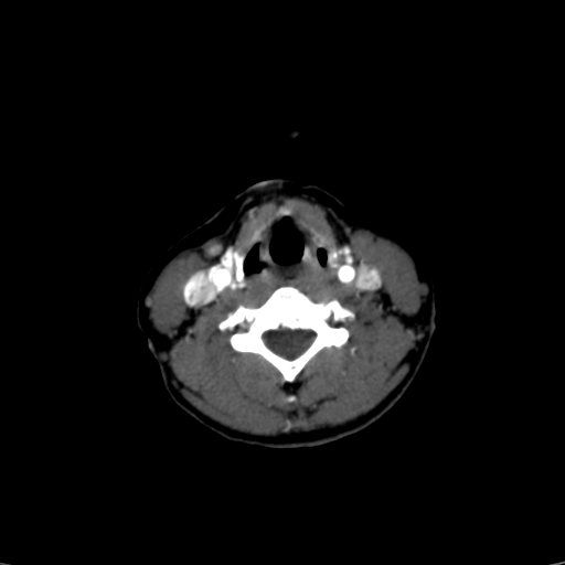 File:Carotid body tumor (Radiopaedia 39845-42300 B 17).jpg