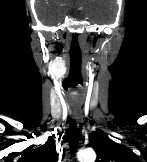 File:Carotid body tumor (Radiopaedia 39845-42300 C 27).jpg