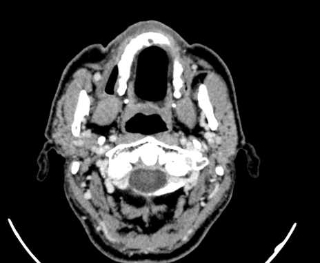 File:Carotid body tumor (Radiopaedia 61750-69757 Axial Post contrast 10).jpg