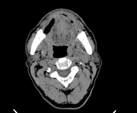 Carotid body tumor (Radiopaedia 61750-69757 Axial non-contrast 33).jpg