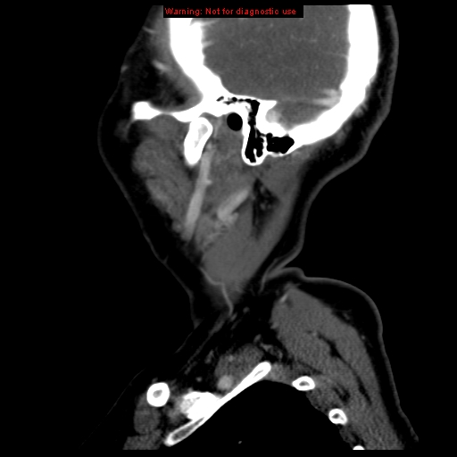 File:Carotid body tumor with lung metastases (Radiopaedia 9301-9986 Sagittal C+ delayed 46).jpg