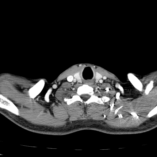 File:Carotid bulb pseudoaneurysm (Radiopaedia 57670-64616 A 59).jpg