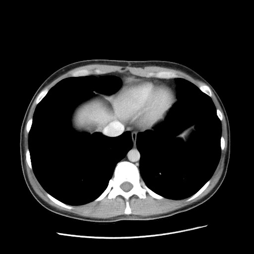 Castleman disease with fibrous pseudotumor in the abdomen (Radiopaedia 77296-89373 A 12).jpg