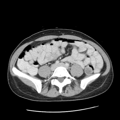 Castleman disease with fibrous pseudotumor in the abdomen (Radiopaedia 77296-89373 A 79).jpg