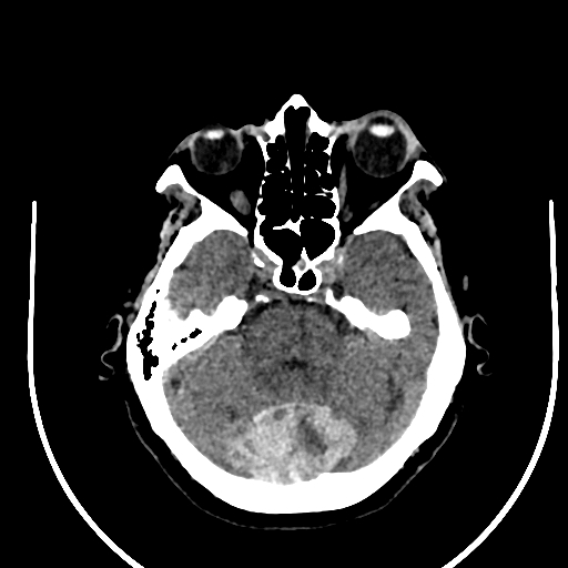 Cavernous hemangioma of the cerebellar falx (Radiopaedia 73025-83723 Axial non-contrast 40).jpg