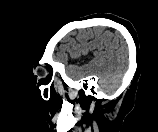 Cavernous hemangioma of the cerebellar falx (Radiopaedia 73025-83723 B 71).jpg