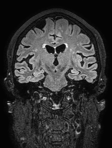 Cavernous hemangioma of the cerebellar falx (Radiopaedia 73025-83724 Coronal FLAIR 183).jpg