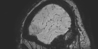 Cavernous hemangioma of the cerebellar falx (Radiopaedia 73025-83724 Sagittal BOLD 182).jpg
