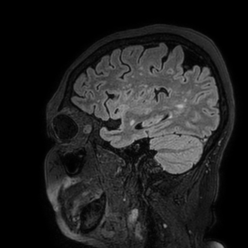 Cavernous hemangioma of the cerebellar falx (Radiopaedia 73025-83724 Sagittal FLAIR 166).jpg