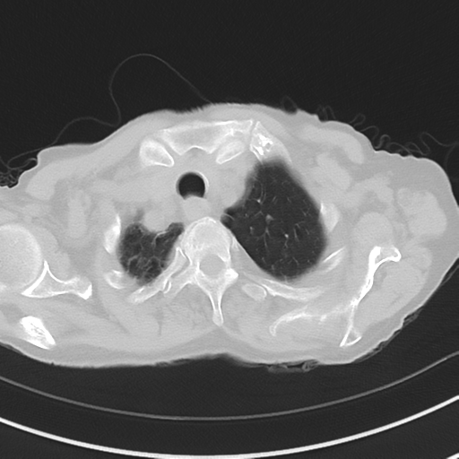 Cavitating pneumonia - lingular segments (Radiopaedia 34386-35678 Axial lung window 10).png