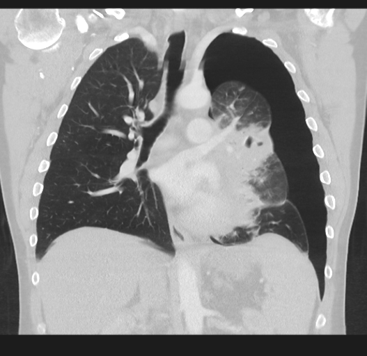 Cavitating pneumonia complicated by pneumothorax (Radiopaedia 48149-52994 Coronal lung window 32).png