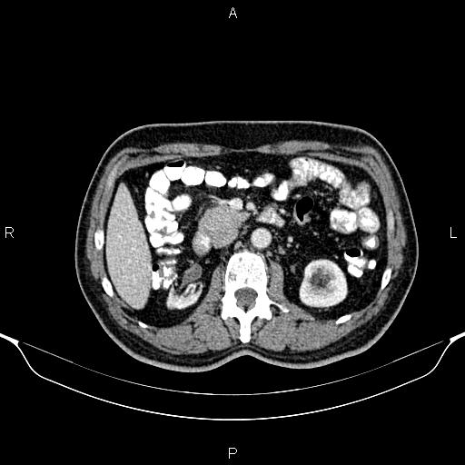Cecal adenocarcinoma (Radiopaedia 85324-100916 B 38).jpg