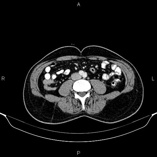 Cecal adenocarcinoma (Radiopaedia 85324-100916 B 57).jpg