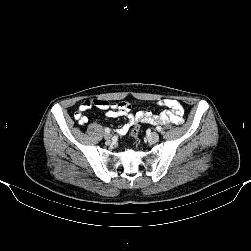 Cecal adenocarcinoma (Radiopaedia 85324-100916 B 76).jpg