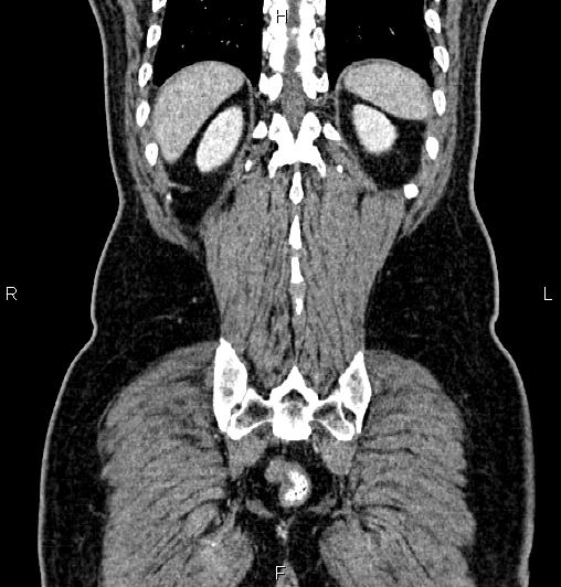 Cecal adenocarcinoma (Radiopaedia 85324-100916 D 58).jpg