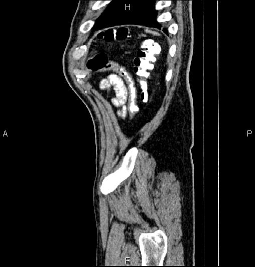 Cecal adenocarcinoma (Radiopaedia 85324-100916 E 86).jpg