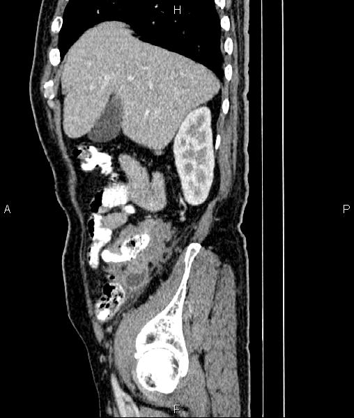 Cecal cancer with appendiceal mucocele (Radiopaedia 91080-108651 E 23).jpg