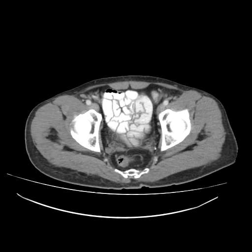 Cecal carcinoma with local lymphadenopathy (Radiopaedia 31428-32240 A 49).jpg