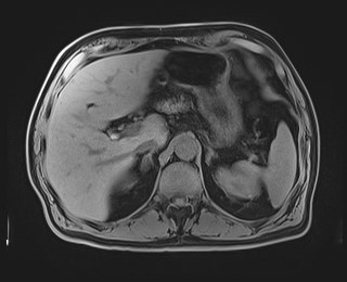 Cecal mass causing appendicitis (Radiopaedia 59207-66532 Axial T1 40).jpg