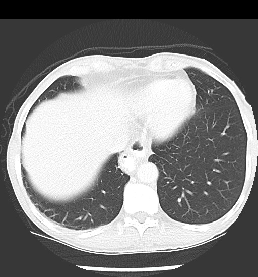 File:Cecal volvulus (Radiopaedia 48543-53513 Axial lung window 10).jpg
