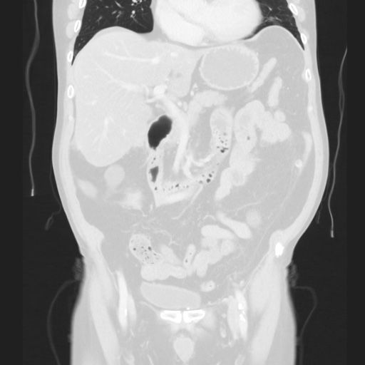 Cecal volvulus (Radiopaedia 75378-86620 Coronal lung window 66).jpg