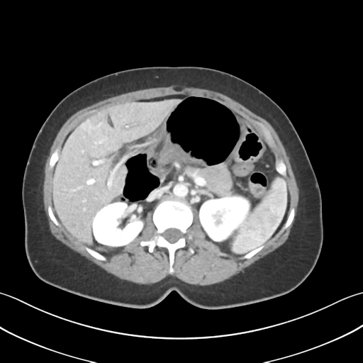 Cecum hernia through the foramen of Winslow (Radiopaedia 46634-51112 A 24).png
