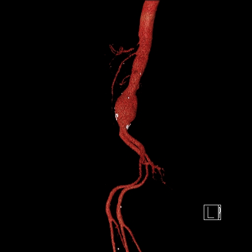 File:Celiac artery compression by the diaphragmatic crurae (Radiopaedia 31739-32666 3D CTA 14).jpg