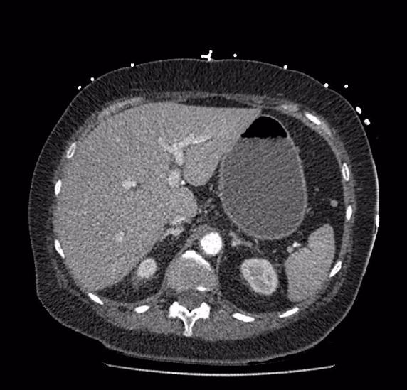Celiac artery severe stenosis and dissection (Radiopaedia 44128-47842 B 20).jpg