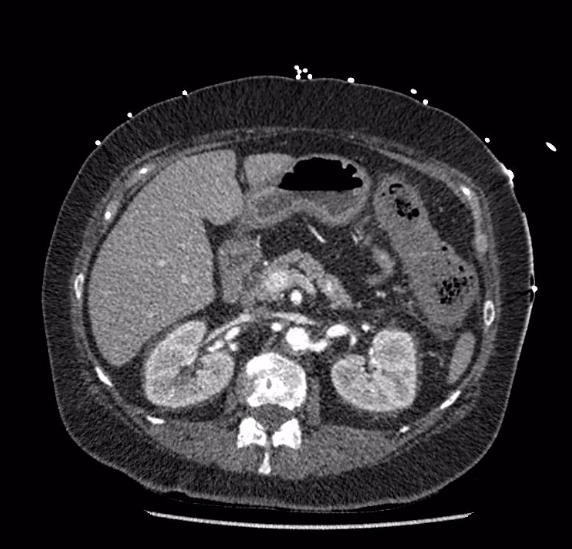 Celiac artery severe stenosis and dissection (Radiopaedia 44128-47842 B 31).jpg