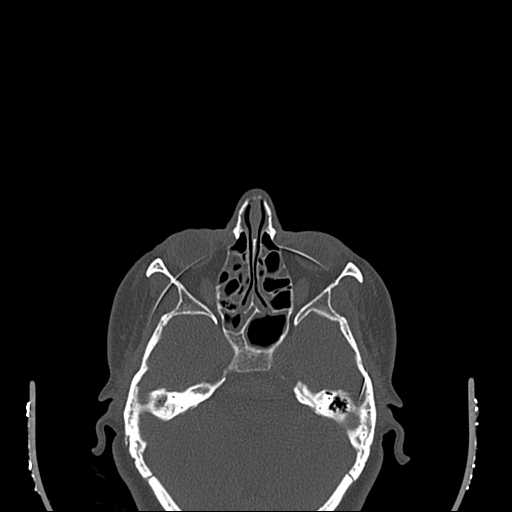 File:Cemento-ossifying fibroma (Radiopaedia 21243-21149 Axial bone window 1).jpg