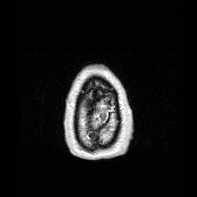 File:Central-variant posterior reversible encephalopathy syndrome (PRES) (Radiopaedia 43880-47358 Axial T1 C+ 167).jpg
