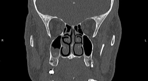 File:Central giant cell granuloma (Radiopaedia 83346-97761 Coronal bone window 16).jpg