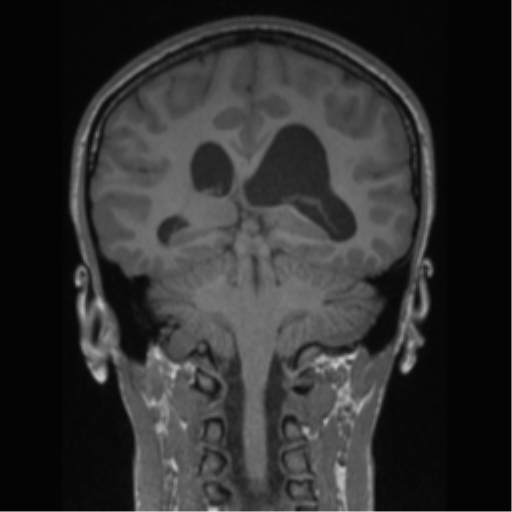 Central neurocytoma (Radiopaedia 37664-39557 Coronal T1 35).png
