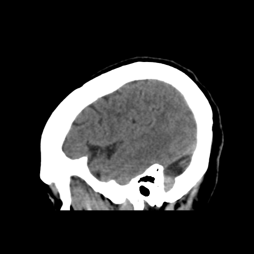 File:Central neurocytoma (Radiopaedia 65317-74346 C 43).png
