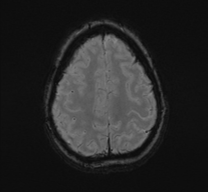 Central neurocytoma (Radiopaedia 70263-80336 Axial SWI 49).jpg