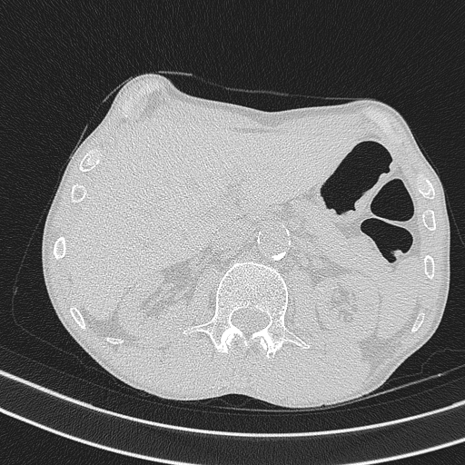 Central venous catheter tip extravasation (Radiopaedia 82828-97113 Axial lung window 87).jpg